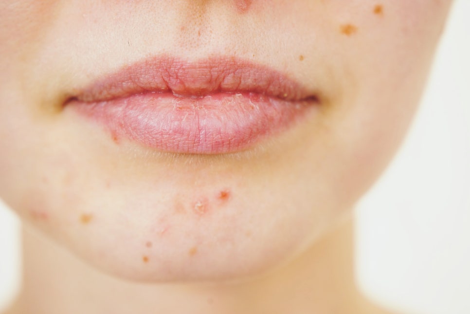 내방역 피부과 피부 장벽 강화 방법 예민한 피부를 위한 단계별 솔루션 관련 이미지 1