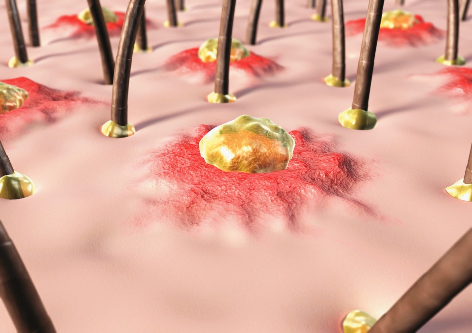 내방 피부과 원장이 알려주는 여드름 부위별 원인과 맞춤 관리법 관련 이미지 2