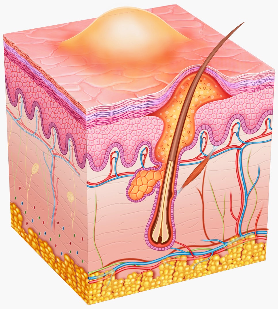 내방동 피부과 모낭염 원인과 증상 여드름과 헷갈리지 마세요 관련 이미지 2