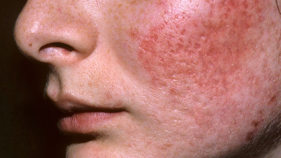 방배 피부과 여드름 흉터 패인 모양과 색깔 따라 치료법 달라져 관련 이미지 1