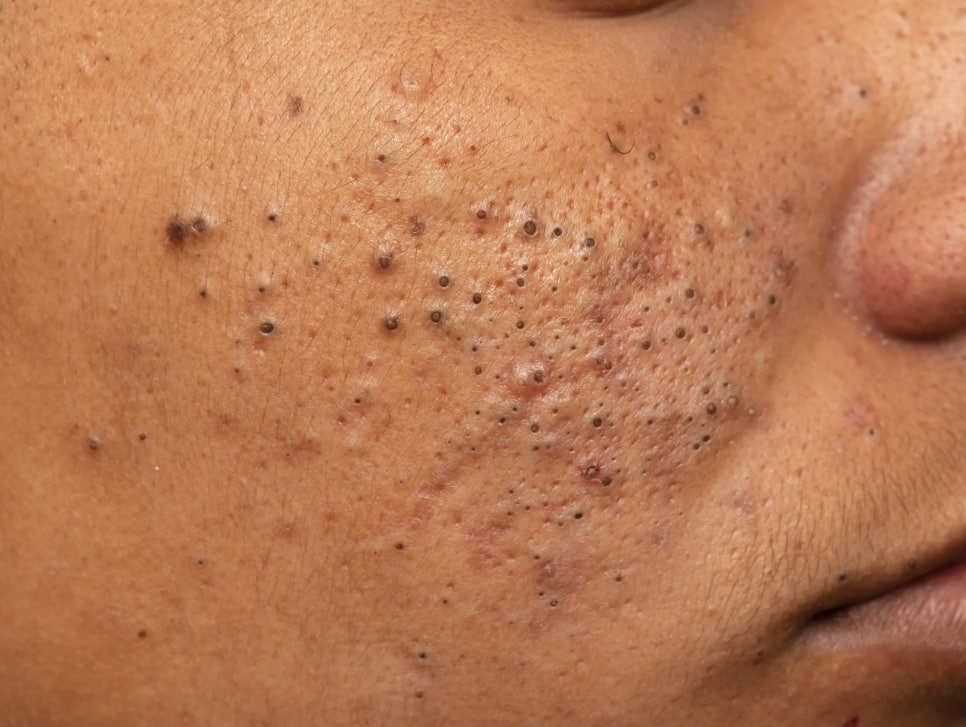 사당역 피부과 모공 축소에 도움이 되는 레이저 치료방법 관련 이미지 1