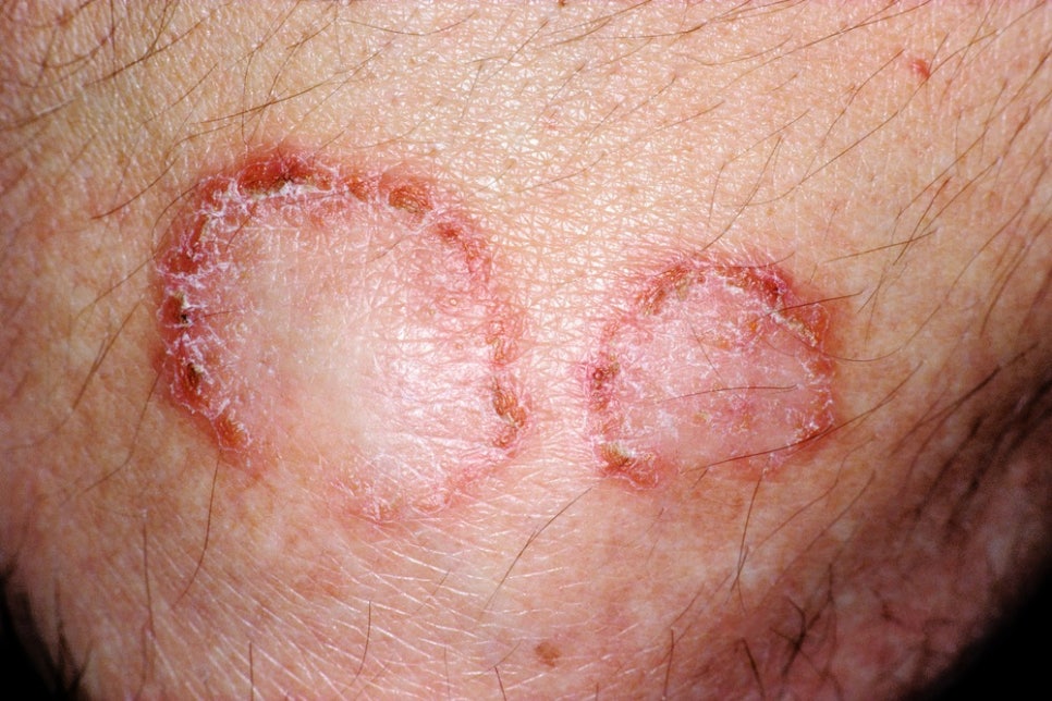 Sadang Station Dermatology Clinic: Causes and Symptoms of Seborrheic Dermatitis—It’s Different from Simple Dry Skin image 2