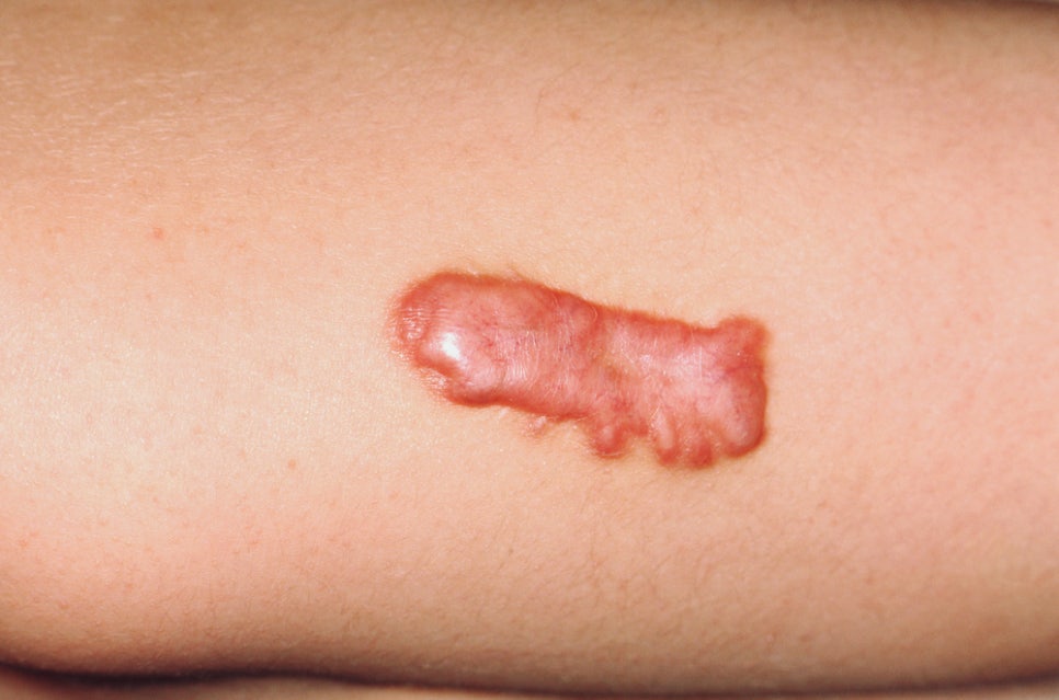 Sadang Station Dermatology: Keloid Scar Treatment—Don’t Ignore a Scar That Keeps Growing and Itching image 2