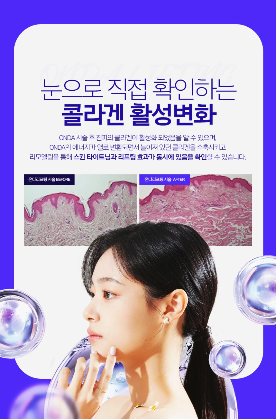 서초역 피부과 이중턱살 리프팅 효과와 얼굴 라인 정리하는 피부과 레이저 치료 관련 이미지 5