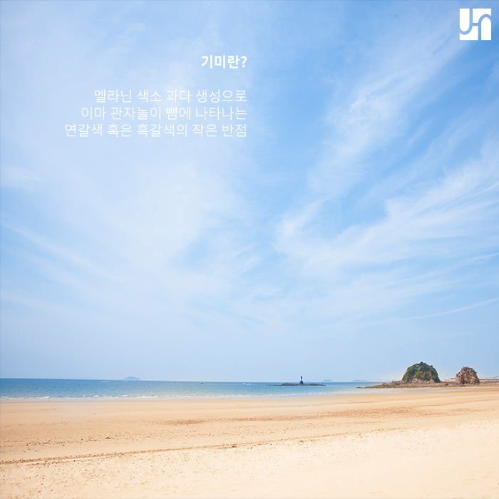 [방배동 피부과] 기미와 주근깨, 어떤 차이가 있나요? 관련 이미지 2