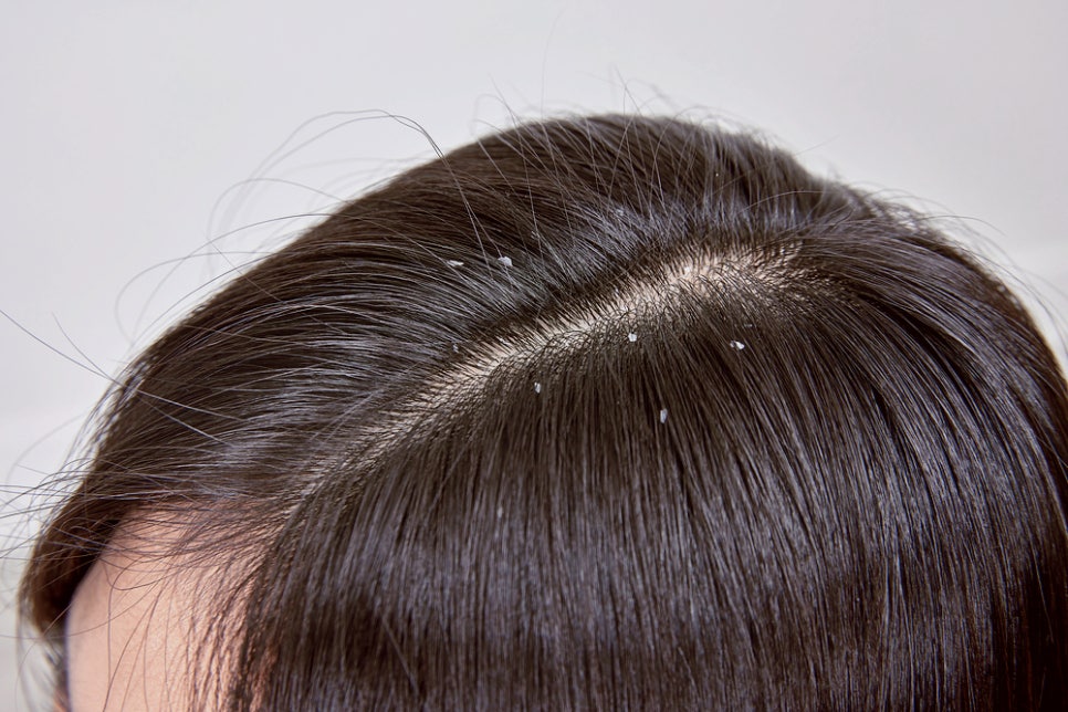 서초동 피부과 머리 비듬 생기는 원인, 지루성 두피염일까? 관련 이미지 2