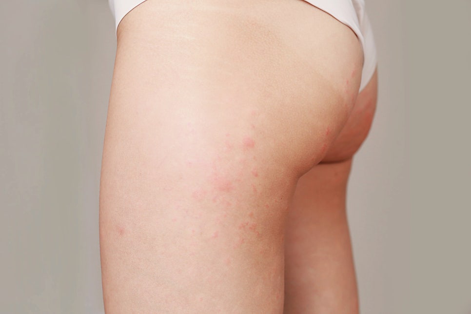 서초 피부과 가려움과 부종 동반한 두드러기 원인과 치료 방법 관련 이미지 2