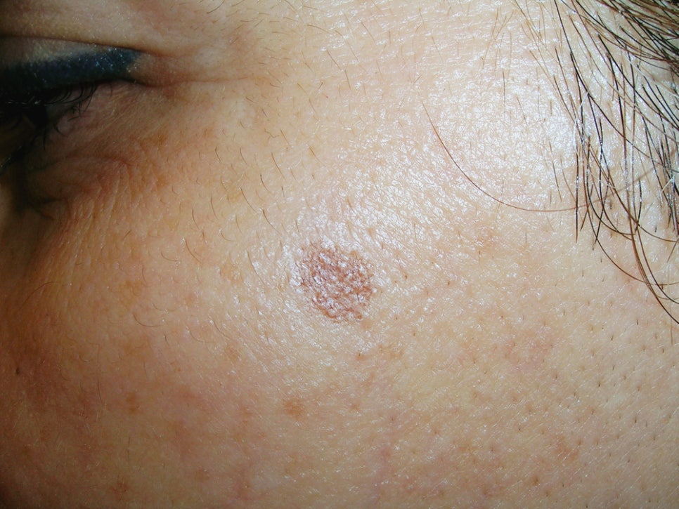 Bangbae Station Dermatology: Laser Removal of Age Spots—Don’t Leave Brown Spots That Develop with Age Untreated image 2