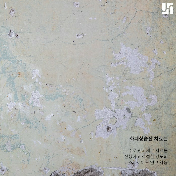 아기 얼굴 동전 습진이 생겼다면 이렇게 해보세요! 관련 이미지 4