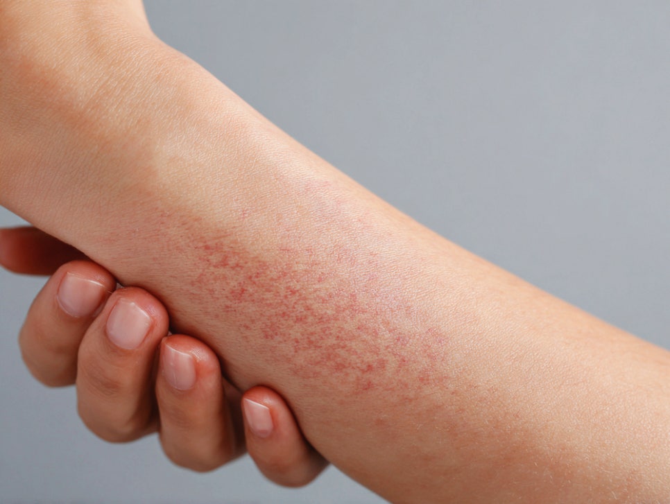 Sadang Station Dermatology Clinic: Why You Shouldn’t Endure the Itch of Atopic Dermatitis Alone as It Worsens with Scratching image 1