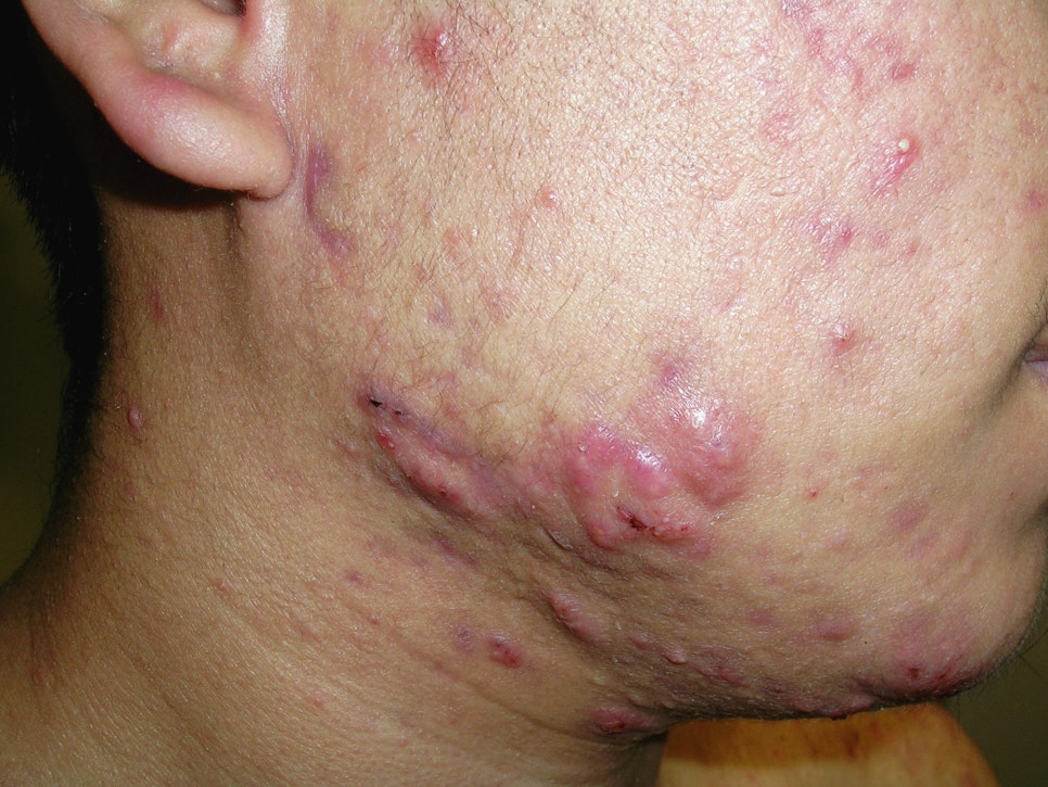 방배역 피부과 깊은 흉터부터 붉은 자국까지 여드름 흉터 치료 연고와 레이저 총정리 관련 이미지 2