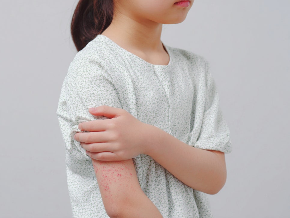 내방역 피부과 환절기 두드러기 치료 날씨가 바뀔 때마다 두드러기가 올라온다면 이유가 있어요 관련 이미지 1