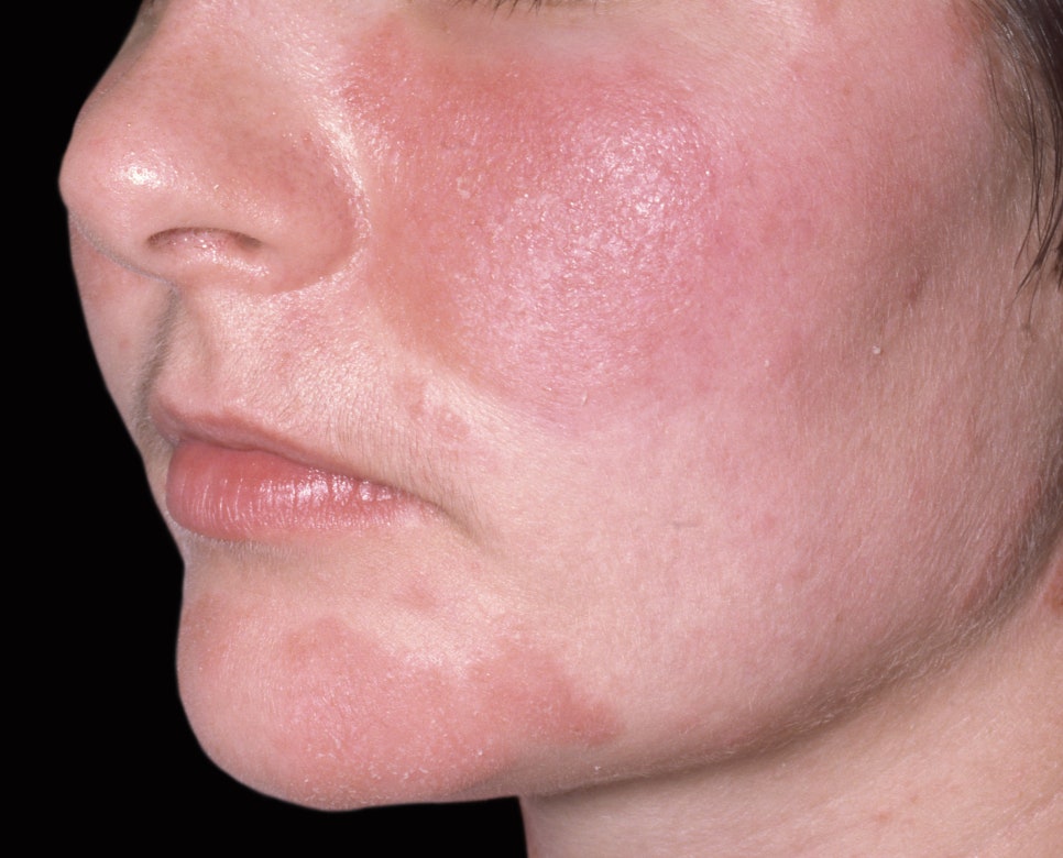 방배동 피부과 안면홍조, 화장으로 가리기보단 혈관을 치료해야 관련 이미지 2