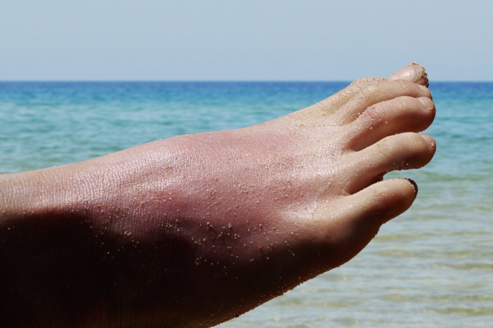 방배동 피부과 화상흉터치료 손상 정도에 따라 다릅니다 관련 이미지 1