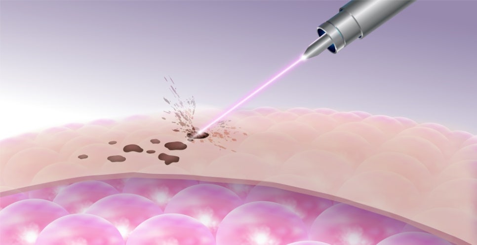 서초구 피부과 여드름흉터에 따른 레이저 치료방법 관련 이미지 3
