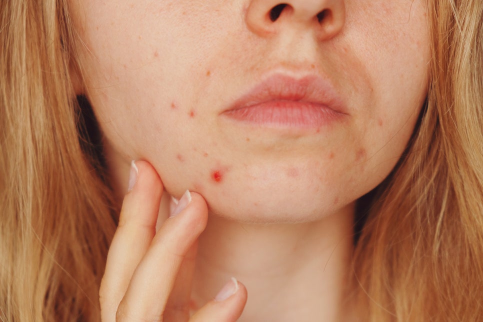 Seocho-gu Dermatology Clinic: How to Remove Dark Marks Left Behind After Scars, Hyperpigmentation, and Wounds Heal image 2