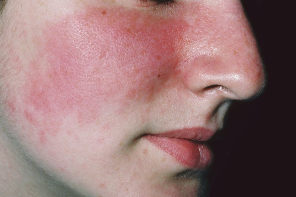 내방동 피부과 자외선 알레르기 피부과 치료 효과와 외출 시 꼭 지켜야 할 주의사항 관련 이미지 1