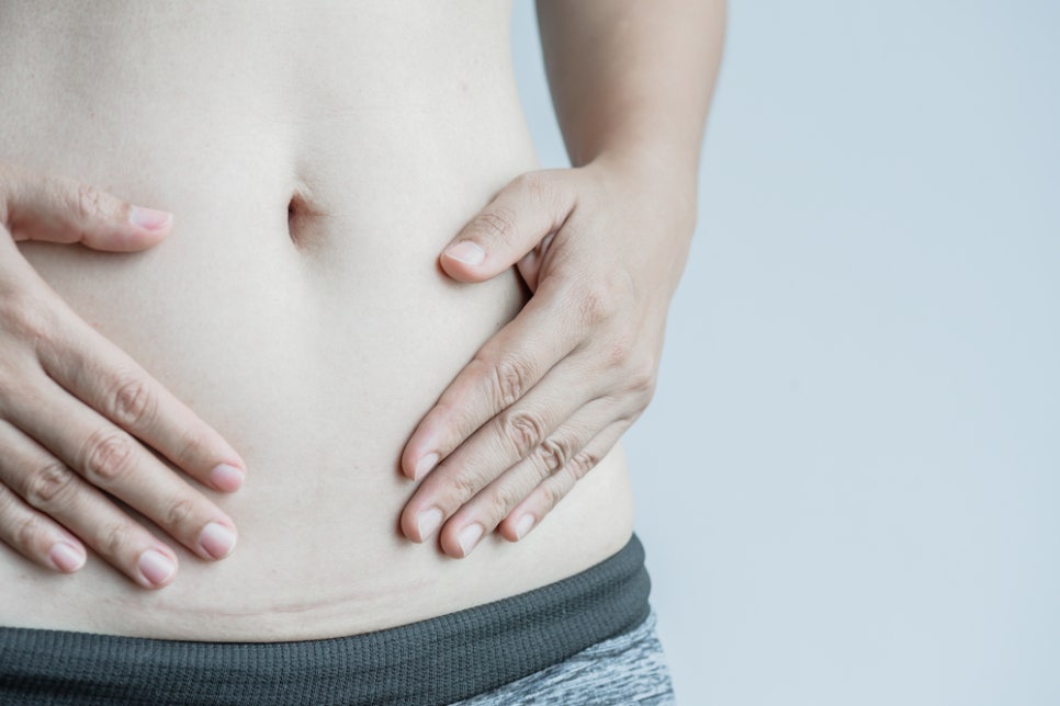 Naebang Station Dermatology Clinic: Surgical Scar Treatment—There Is a Reason Surgical Marks Do Not Disappear Over Time image 2