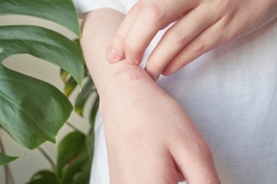 Sadang-dong Dermatology Clinic: Psoriasis Treatment—There Is a Reason Why Skin That Gets Worse the More You Scratch Keeps Recurring image 2