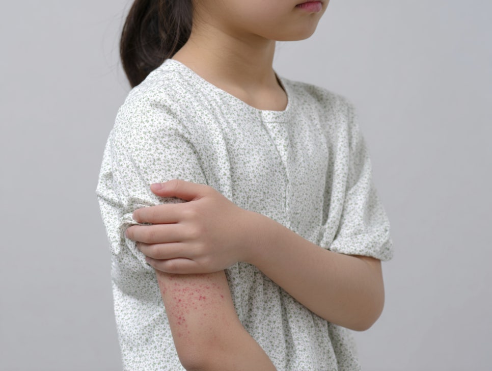 사당동피부과 두드러기 증상에 따라 치료법도 달라져 관련 이미지 3