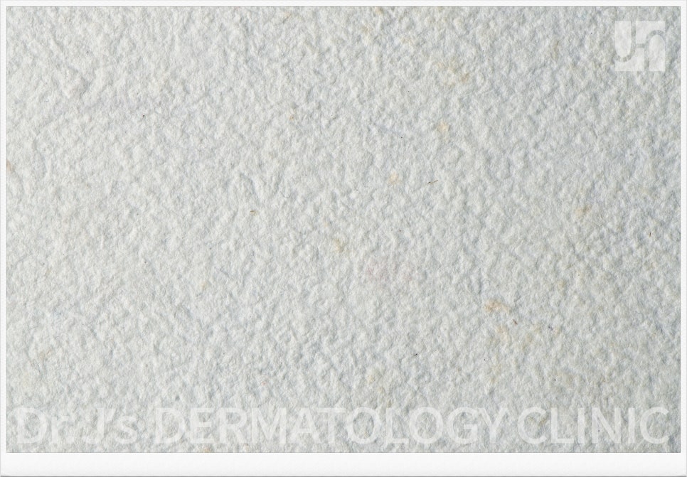 방배 기미제거 레이저 피부과 전문의와 상의하세요. 관련 이미지 1