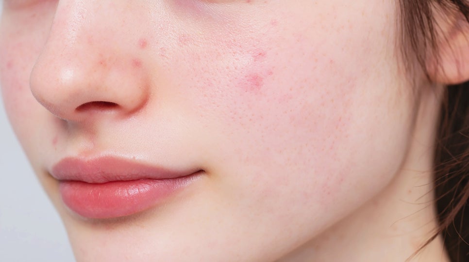 사당역 피부과 화장품 바꿔도 예민한 피부라면 피부 장벽 강화로 근본부터 잡아요 관련 이미지 1