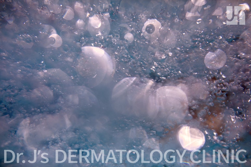 대상포진 통증, 이런 증상이 보인다면 대상포진 치료 필요 관련 이미지 2