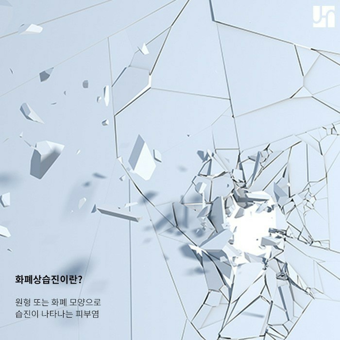 아기 얼굴 동전 습진이 생겼다면 이렇게 해보세요! 관련 이미지 3