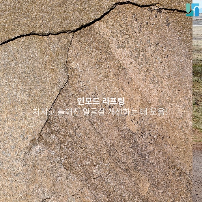 피부 탄력 증진을 위한 선택! 인모드 리프팅 관련 이미지 1