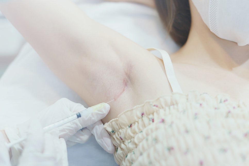 Sadang Station Dermatology: Keloid Scar Treatment—Don’t Ignore a Scar That Keeps Growing and Itching image 1