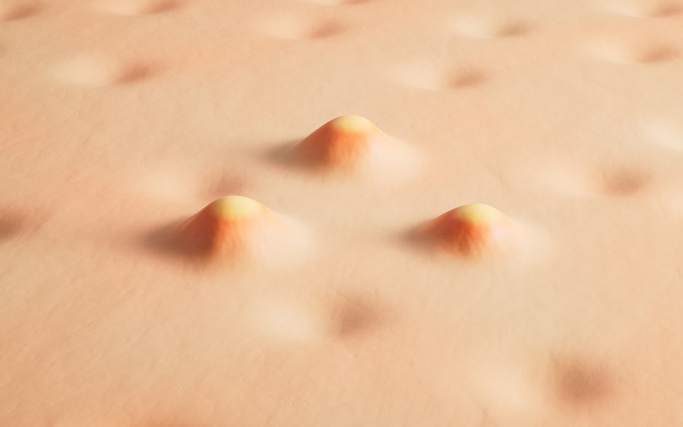 내방역 피부과 넓고 쳐진 모공 관리로 매끈한 달걀 피부 되는 법 관련 이미지 1