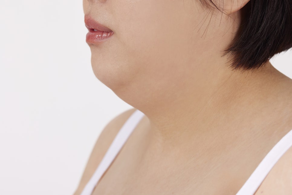 서초동 피부과 이중턱살 리프팅 다이어트해도 얼굴살은 그대로라면 관련 이미지 1