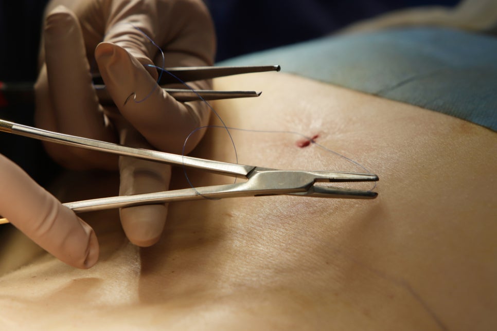 Naebang Station Dermatology Clinic: Surgical Scar Treatment—There Is a Reason Surgical Marks Do Not Disappear Over Time image 1