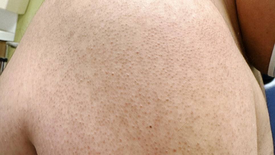 서초구 피부과 모공각화증 치료 닭살 피부 없애는 올바른 피부관리법 관련 이미지 1