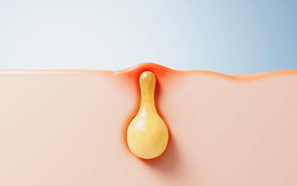 내방 피부과 원장이 알려주는 여드름 부위별 원인과 맞춤 관리법 관련 이미지 3