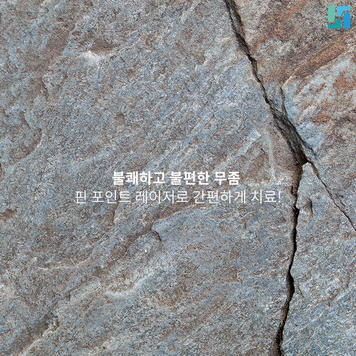 불쾌하고 불편한 무좀, 핀 포인트 레이저로 간편하게 치료! 관련 이미지 1