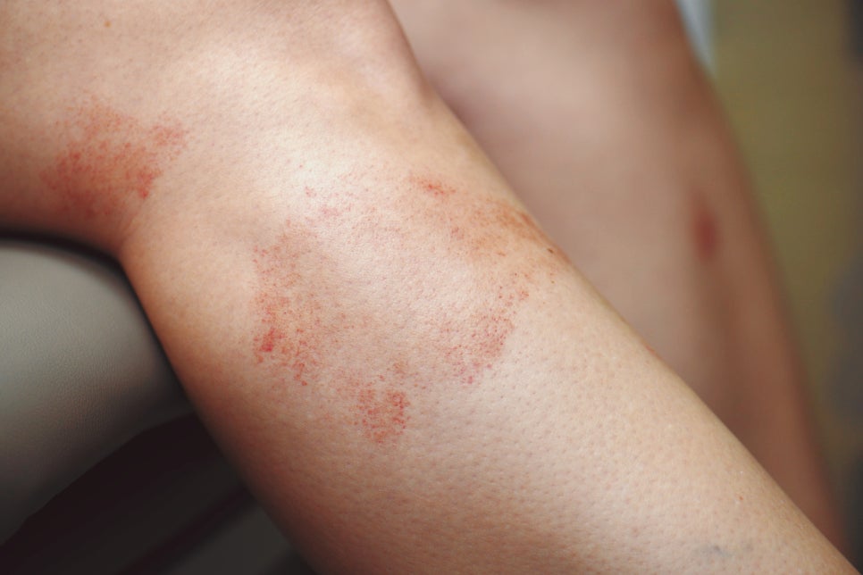 사당동 피부과 피부 색소침착 원인과 효과적인 레이저 치료법 관련 이미지 3