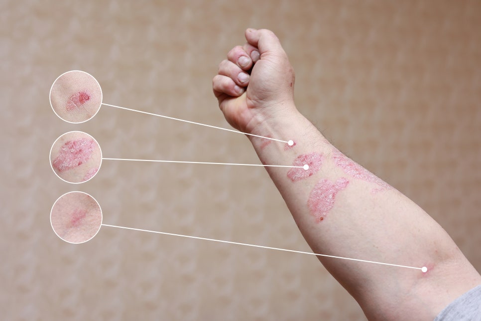 사당역 피부과 건선, 숨기지 말고 면역부터 다스려야 합니다 관련 이미지 2