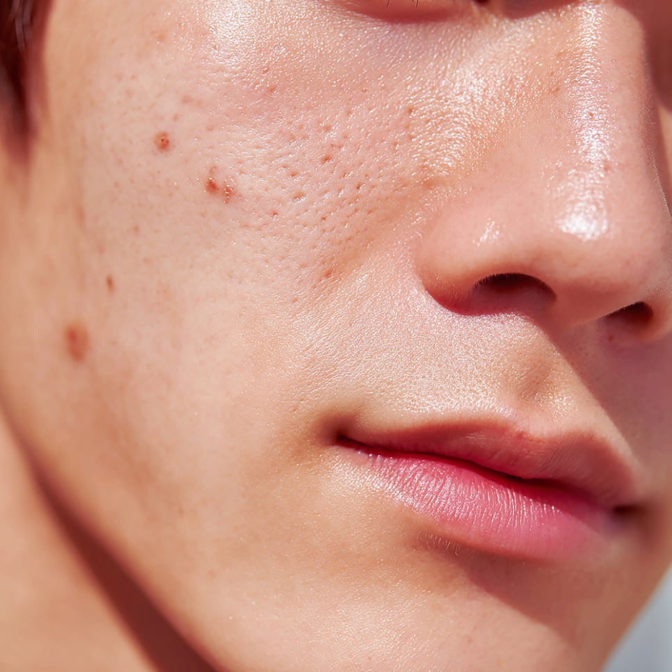 방배역 피부과 늘어진 모공 줄이는 시술 추천과 사후 관리 총정리 관련 이미지 2