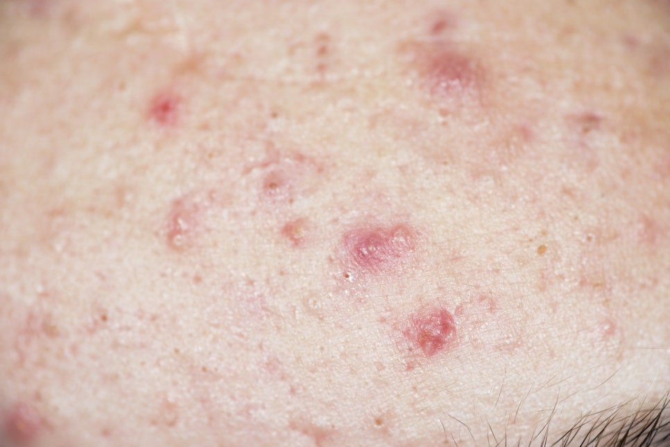 내방동 피부과 여드름 원인과 모양에 따른 치료방법에 대해 관련 이미지 4