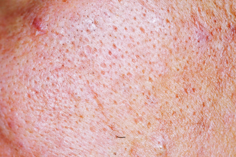 방배역 피부과 늘어진 모공 줄이는 시술 추천과 사후 관리 총정리 관련 이미지 1