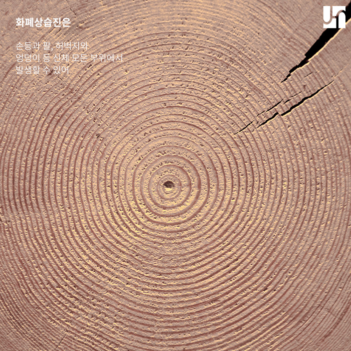 환절기에 주의하세요! 관련 이미지 3