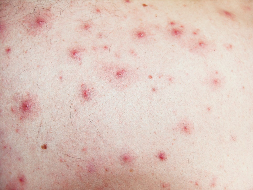 사당동 피부과 여드름 흉터 마데카솔 사용 전 꼭 알아야 할 주의사항과 부작용 관련 이미지 2