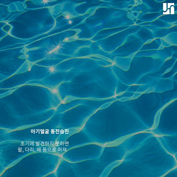 아기 얼굴 동전 습진이 생겼다면 이렇게 해보세요! 관련 이미지 2