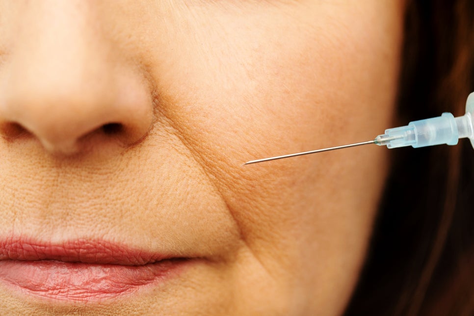 Sadang Station Dermatology Clinic: Why Nasolabial Fold Filler Should Not Simply Fill the Lines image 5