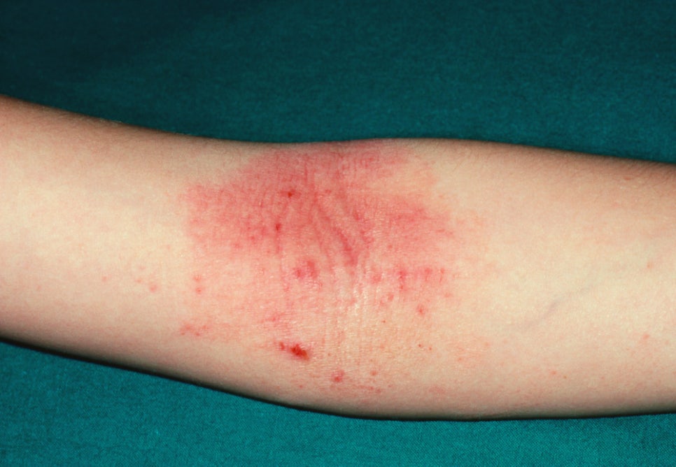 Sadang Station Dermatology Clinic: Why You Shouldn’t Endure the Itch of Atopic Dermatitis Alone as It Worsens with Scratching image 3