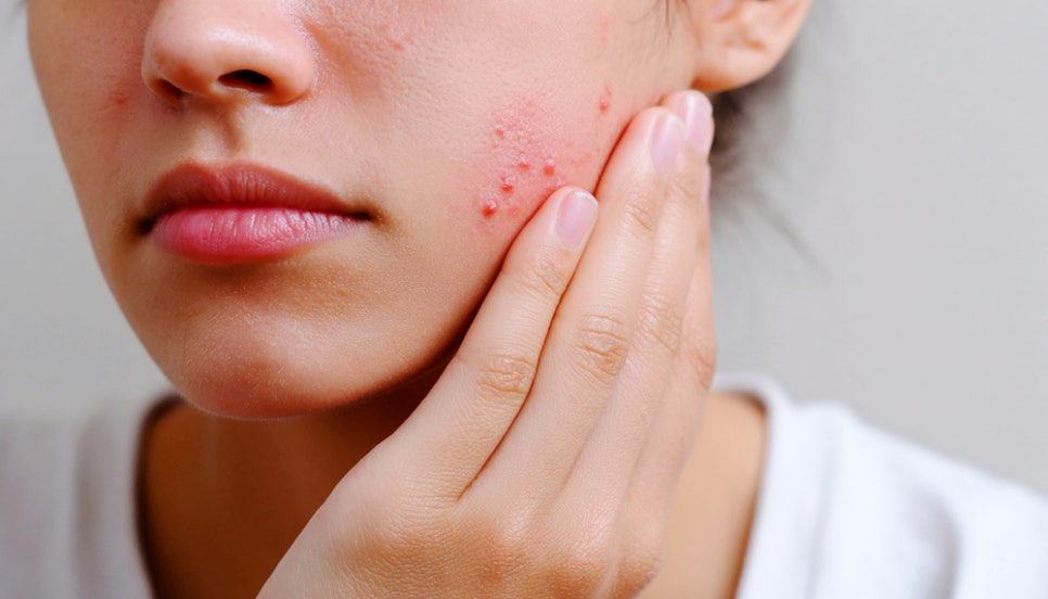 Sadang Station Dermatology Clinic: How to Approach Pigmentation Treatment When Acne Marks Remain Brown image 1