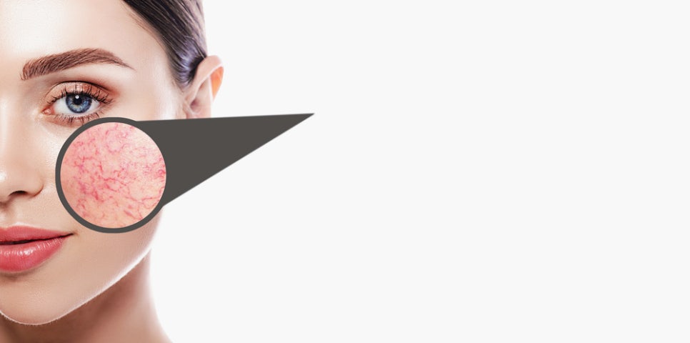 Bangbae Station Dermatology: Treatment Is Needed If Your Cheeks Are Always Red and Fine Blood Vessels Are Visible image 1