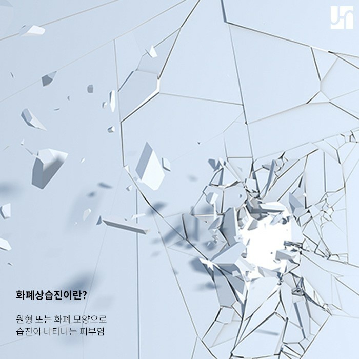 화폐상 습진 치료는 어떻게 해야 하나요? 관련 이미지 2