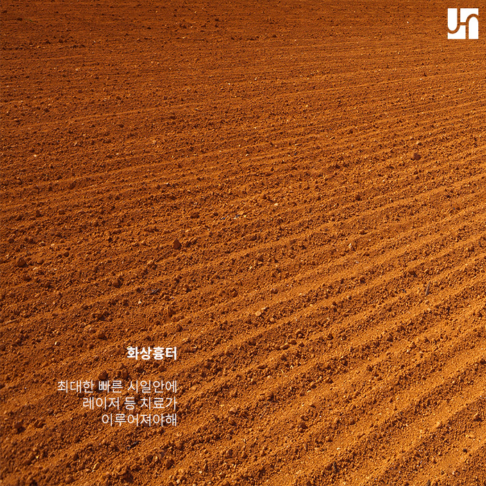 화상피부벗겨짐, 초기치료가 중요해 관련 이미지 3